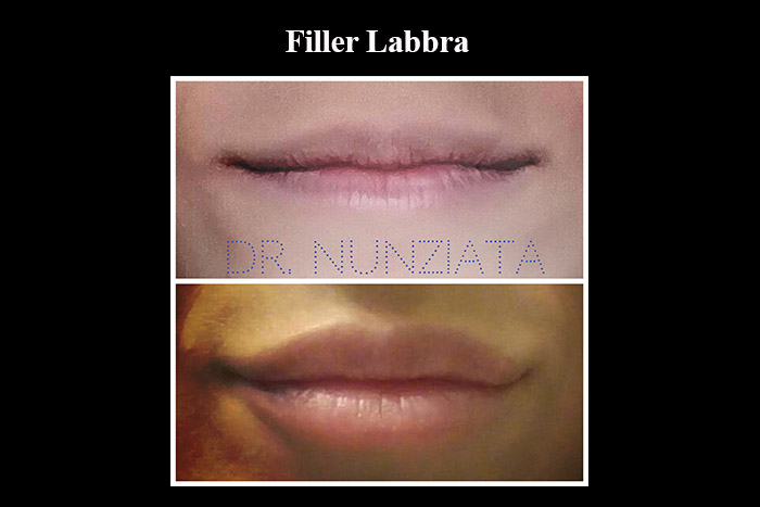 Fillers prima e dopo – Filler Labbra – Dr. Vincenzo Nunziata, chirurgo plastico – foto 9