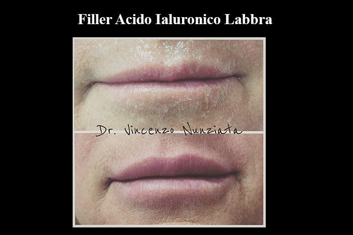Fillers prima e dopo – Filler Labbra – Dr. Vincenzo Nunziata, chirurgo plastico – foto 12