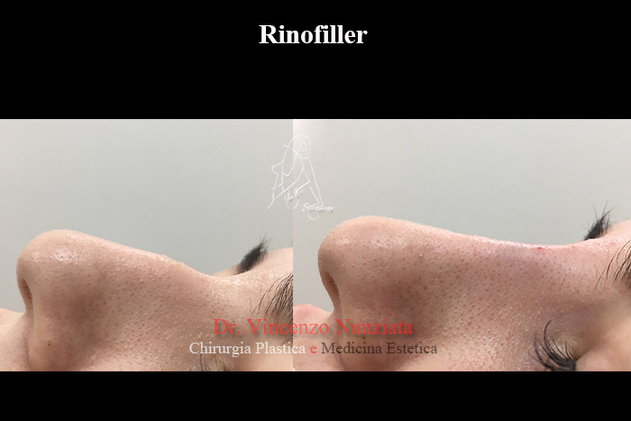 Fillers prima e dopo – Rinofiller – Dr. Vincenzo Nunziata, chirurgo plastico – foto 3