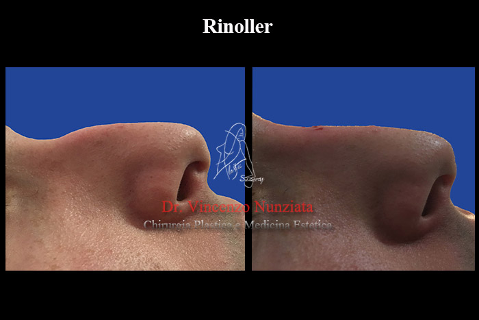 Fillers prima e dopo – Rinofiller – Dr. Vincenzo Nunziata, chirurgo plastico
