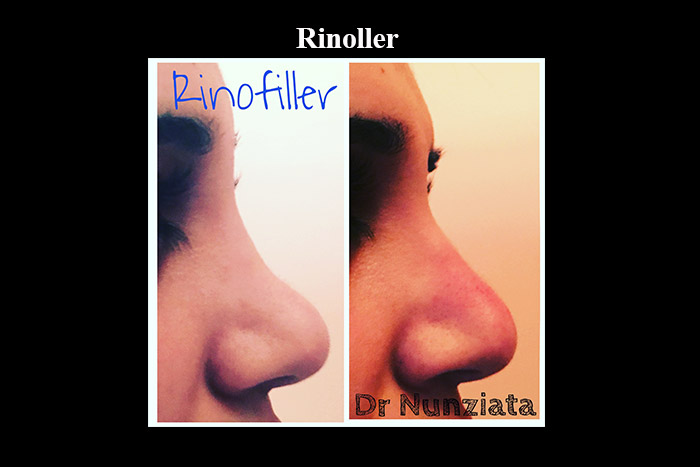 Fillers prima e dopo – Rinofiller – Dr. Vincenzo Nunziata, chirurgo plastico – foto 2