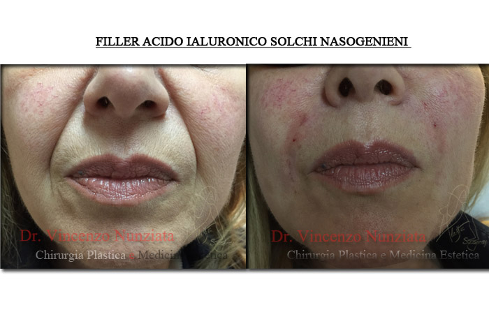 Fillers prima e dopo – Filler rughe – Dr. Vincenzo Nunziata, chirurgo plastico – foto 2