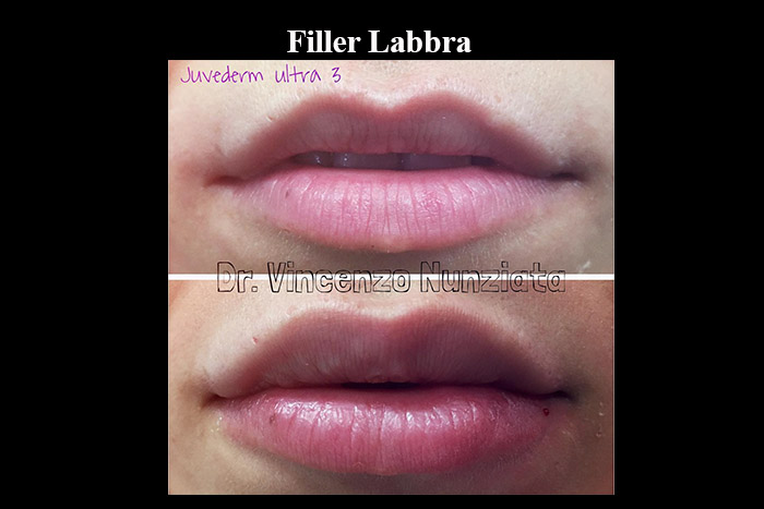 Fillers prima e dopo – Filler Labbra – Dr. Vincenzo Nunziata, chirurgo plastico – foto 4