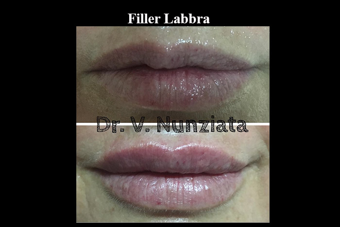 Fillers prima e dopo – Filler Labbra – Dr. Vincenzo Nunziata, chirurgo plastico – foto 3