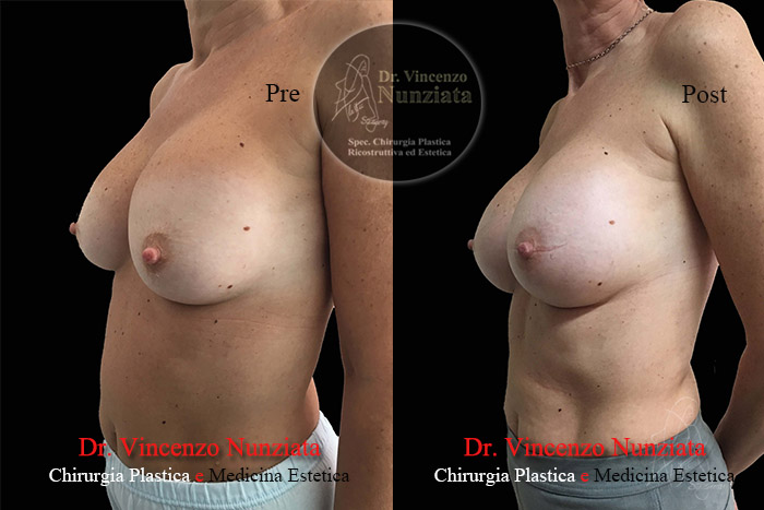 Revisioni mammarie prima e dopo – Paziente 3 – Dr. Vincenzo Nunziata, chirurgo plastico – foto 4