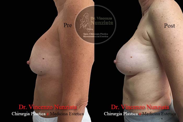 Revisioni mammarie prima e dopo – Paziente 3 – Dr. Vincenzo Nunziata, chirurgo plastico – foto 3