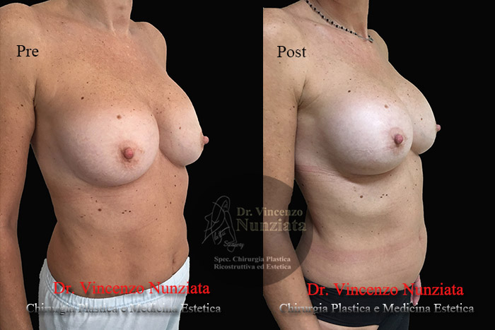 Revisioni mammarie prima e dopo – Paziente 3 – Dr. Vincenzo Nunziata, chirurgo plastico – foto 2