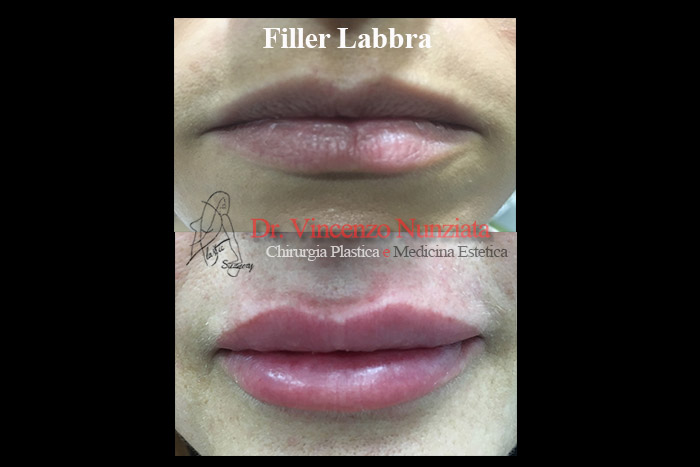 Fillers prima e dopo – Filler Labbra – Dr. Vincenzo Nunziata, chirurgo plastico – foto 2