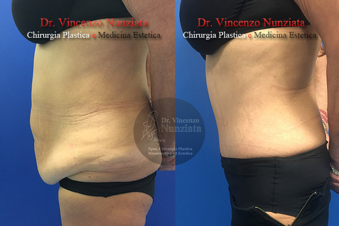 Addominoplastica prima e dopo – Paziente 14 – Dr. Vincenzo Nunziata, chirurgo plastico – foto 2