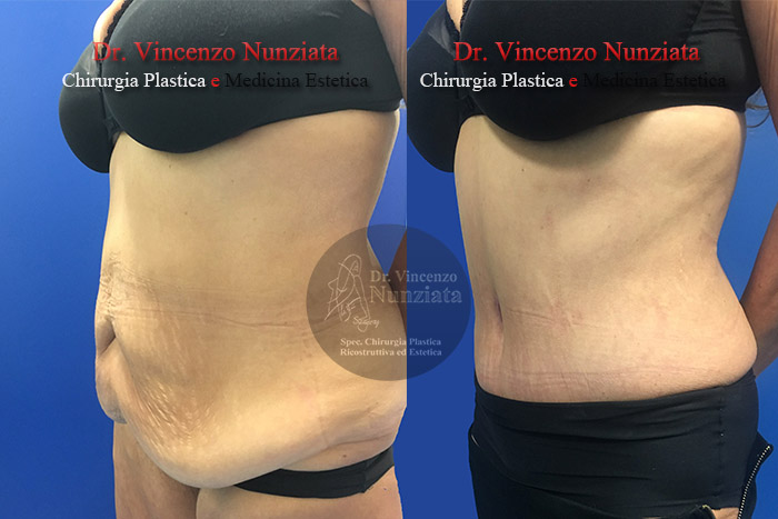 Addominoplastica prima e dopo – Paziente 14 – Dr. Vincenzo Nunziata, chirurgo plastico – foto 3