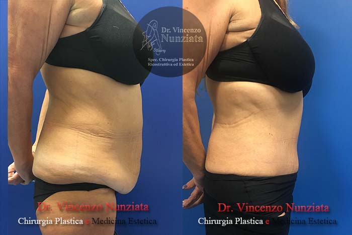 Addominoplastica prima e dopo – Paziente 14 – Dr. Vincenzo Nunziata, chirurgo plastico – foto 4