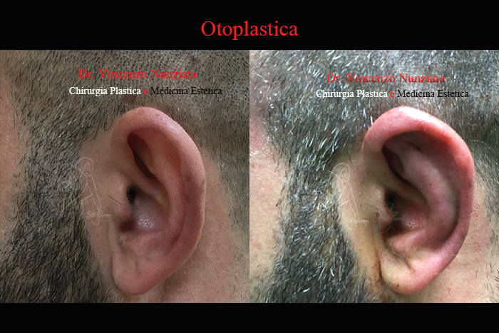 Otoplastica prima e dopo – Paziente 5 – Dr. Vincenzo Nunziata, chirurgo plastico – foto 2