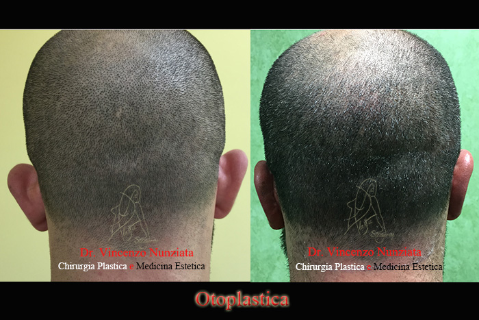 Otoplastica prima e dopo – Paziente 5 – Dr. Vincenzo Nunziata, chirurgo plastico