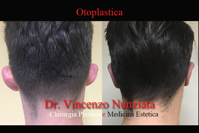 Otoplastica prima e dopo – Paziente 6 – Dr. Vincenzo Nunziata, chirurgo plastico