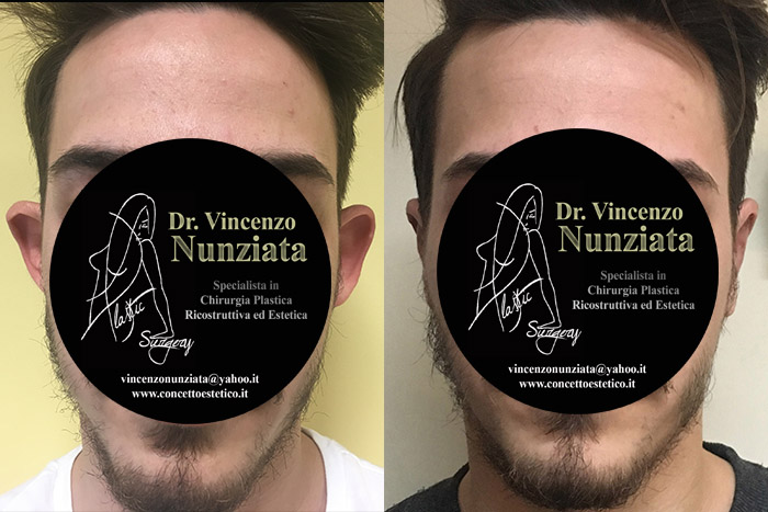 Otoplastica prima e dopo – Paziente 6 – Dr. Vincenzo Nunziata, chirurgo plastico – foto 2