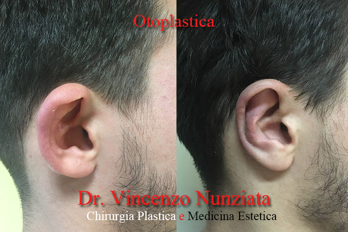 Otoplastica prima e dopo – Paziente 6 – Dr. Vincenzo Nunziata, chirurgo plastico – foto 3
