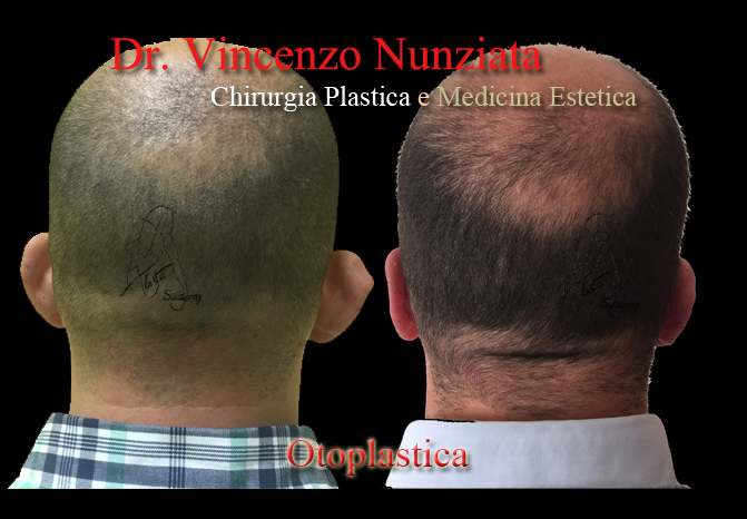 Otoplastica prima e dopo – Paziente 8 – Dr. Vincenzo Nunziata, chirurgo plastico