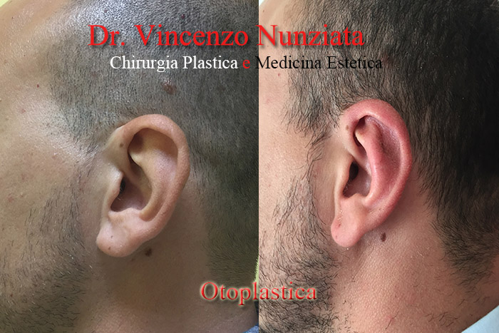 Otoplastica prima e dopo – Paziente 8 – Dr. Vincenzo Nunziata, chirurgo plastico – foto 2