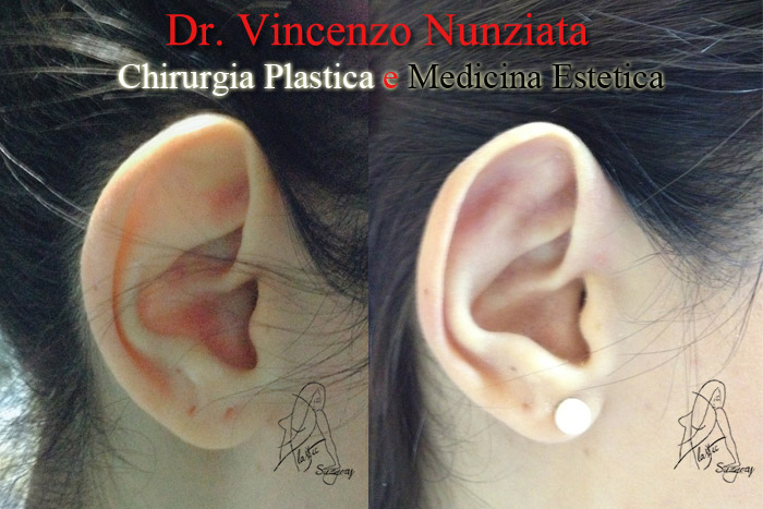 Otoplastica prima e dopo – Paziente 7 – Dr. Vincenzo Nunziata, chirurgo plastico