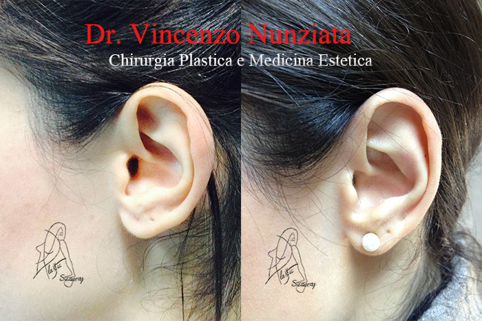 Otoplastica prima e dopo – Paziente 7 – Dr. Vincenzo Nunziata, chirurgo plastico – foto 2