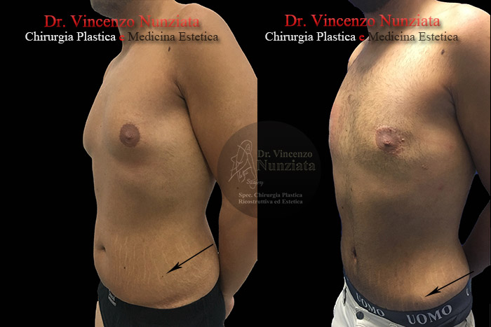 Ginecomastia prima e dopo – Paziente 6 – Dr. Vincenzo Nunziata, chirurgo plastico – foto 2
