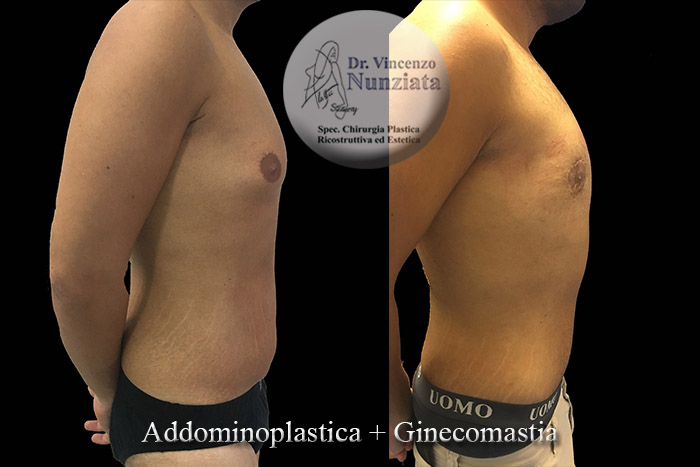 Ginecomastia prima e dopo – Paziente 6 – Dr. Vincenzo Nunziata, chirurgo plastico – foto 3