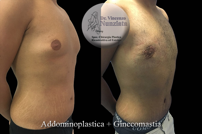 Ginecomastia prima e dopo – Paziente 6 – Dr. Vincenzo Nunziata, chirurgo plastico – foto 4