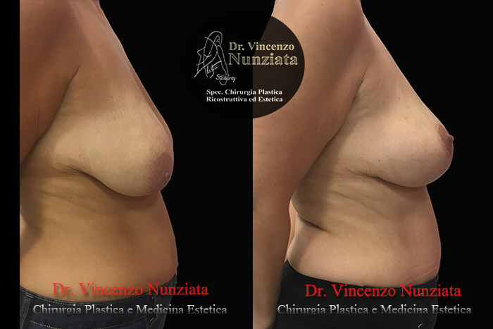 Mastopessi prima e dopo – Paziente 7 – Dr. Vincenzo Nunziata, chirurgo plastico – foto 2