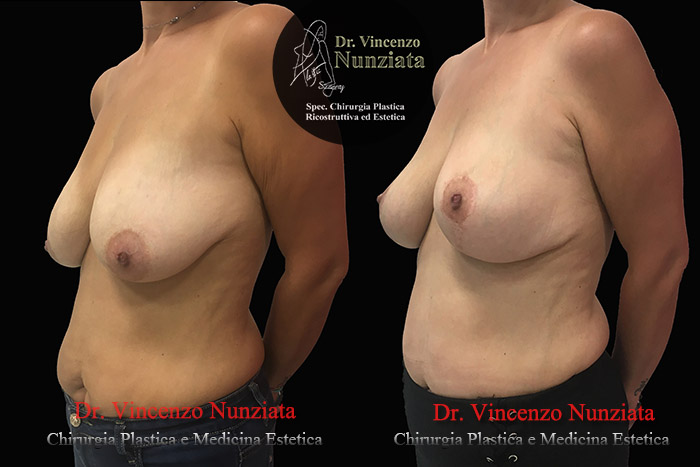 Mastopessi prima e dopo – Paziente 7 – Dr. Vincenzo Nunziata, chirurgo plastico – foto 3