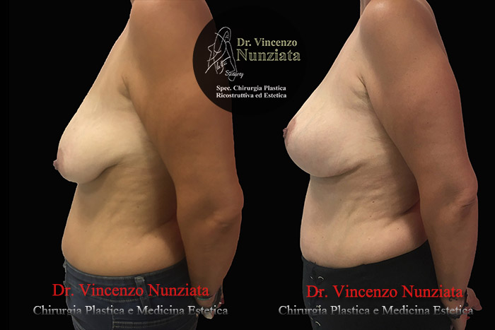 Mastopessi prima e dopo – Paziente 7 – Dr. Vincenzo Nunziata, chirurgo plastico – foto 4