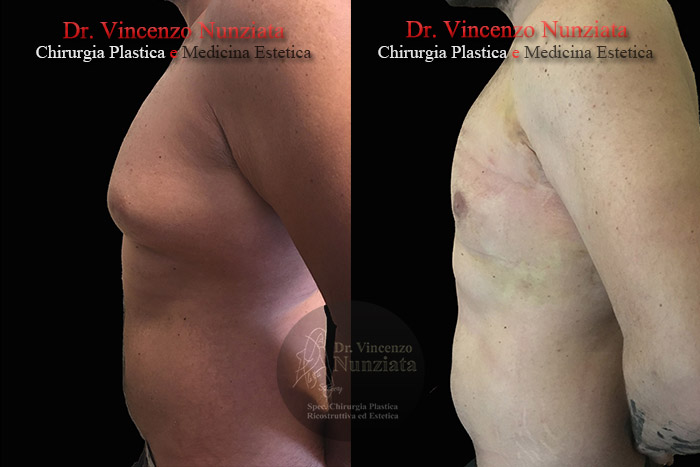 Ginecomastia prima e dopo – Paziente 7 – Dr. Vincenzo Nunziata, chirurgo plastico – foto 3