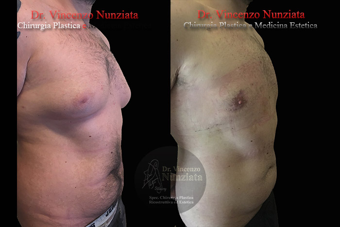 Ginecomastia prima e dopo – Paziente 7 – Dr. Vincenzo Nunziata, chirurgo plastico – foto 2