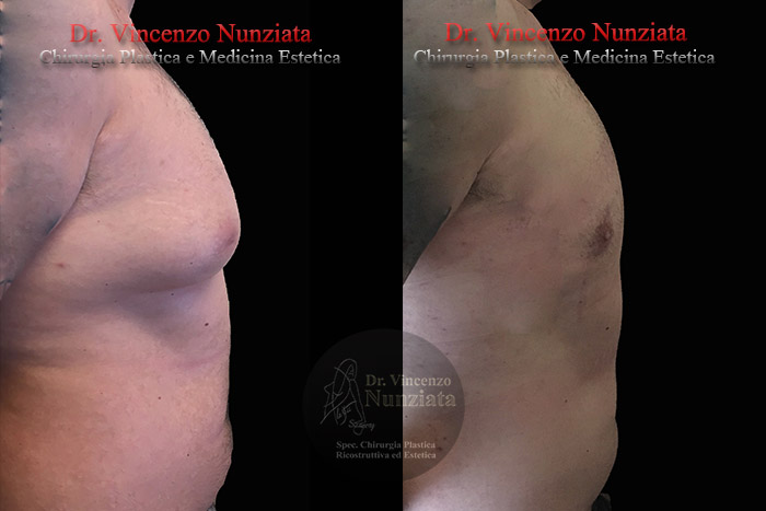 Ginecomastia prima e dopo – Paziente 7 – Dr. Vincenzo Nunziata, chirurgo plastico – foto 4