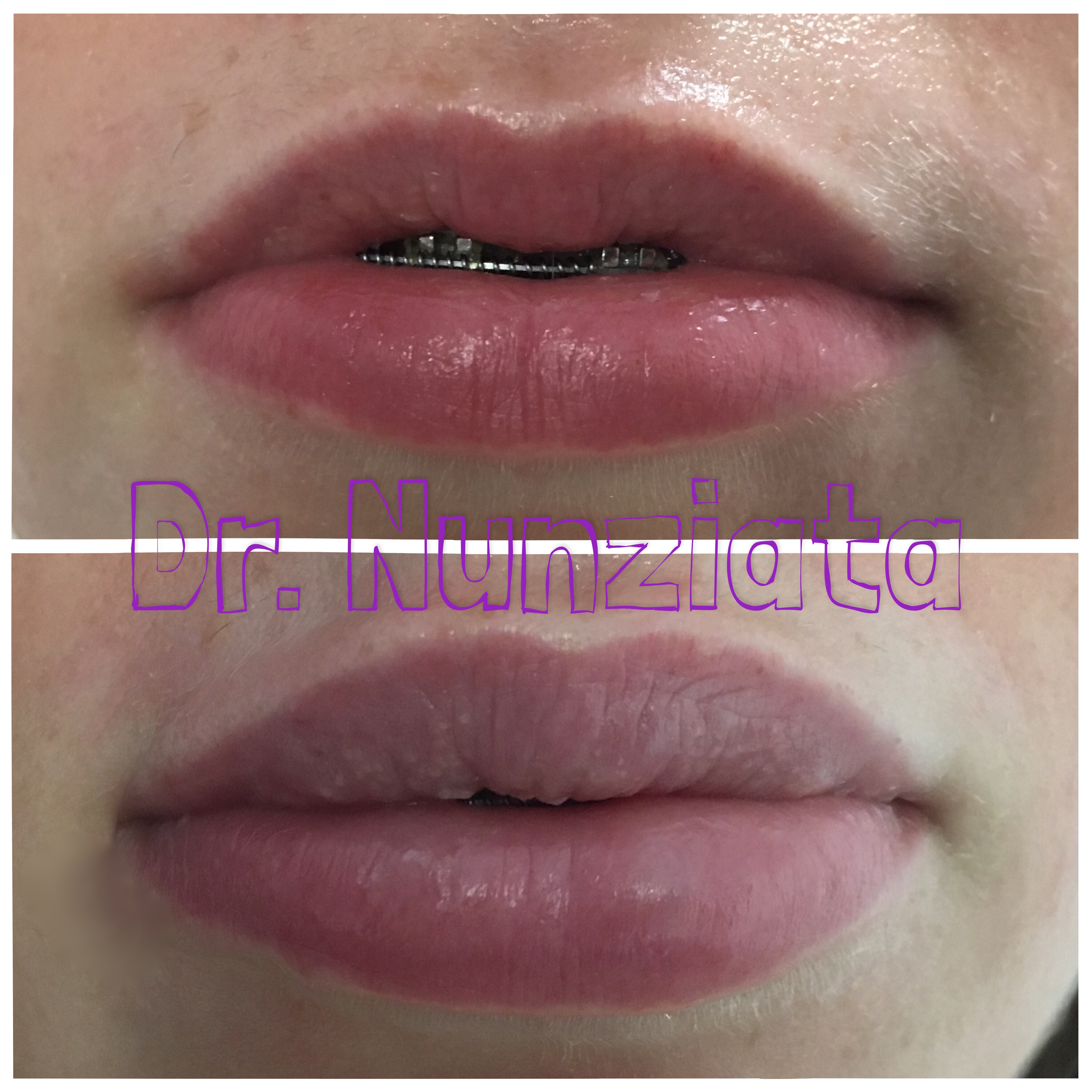 Fillers prima e dopo – Filler Labbra – Dr. Vincenzo Nunziata, chirurgo plastico – foto 13
