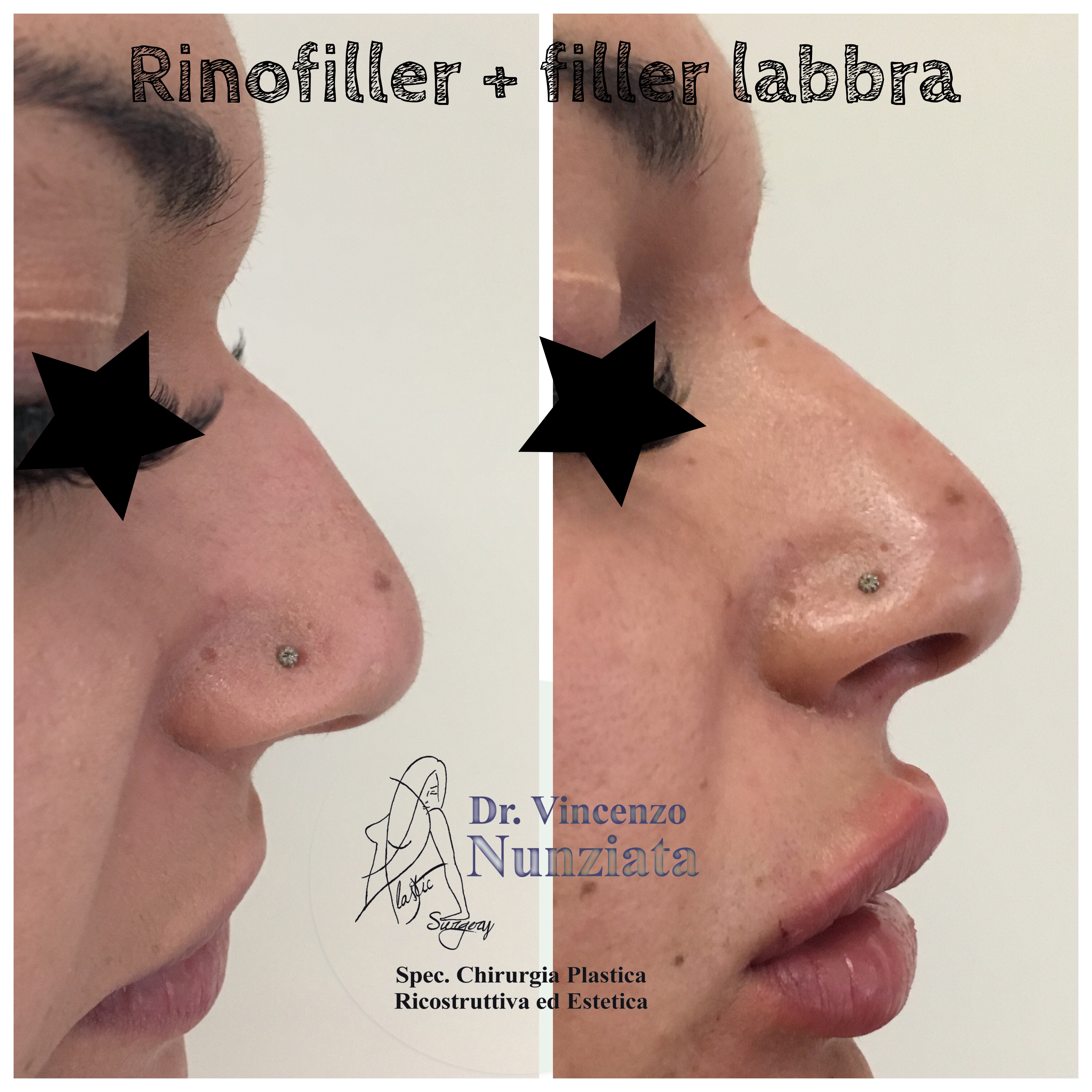 Fillers prima e dopo – Rinofiller – Dr. Vincenzo Nunziata, chirurgo plastico – foto 4