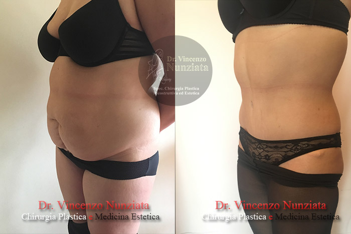 Addominoplastica prima e dopo – Paziente 16 – Dr. Vincenzo Nunziata, chirurgo plastico – foto 4