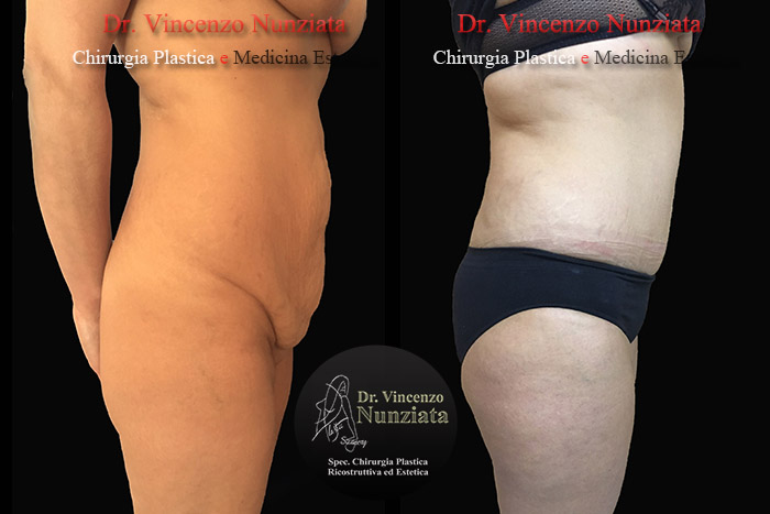 Addominoplastica prima e dopo – Paziente 15 – Dr. Vincenzo Nunziata, chirurgo plastico – foto 3