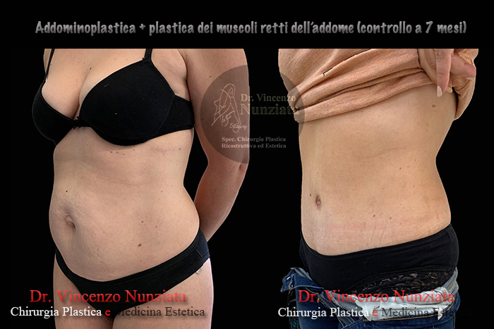 Addominoplastica prima e dopo – Paziente 17 – Dr. Vincenzo Nunziata, chirurgo plastico – foto 3