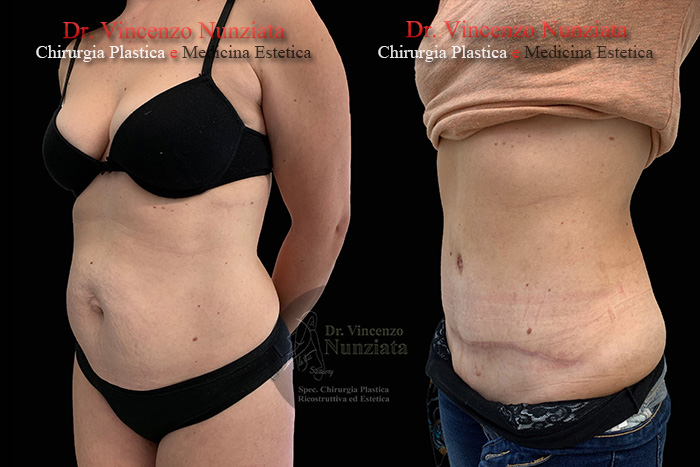 Addominoplastica prima e dopo – Paziente 17 – Dr. Vincenzo Nunziata, chirurgo plastico – foto 2