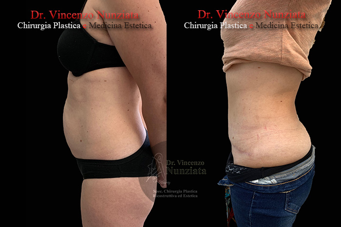 Addominoplastica prima e dopo – Paziente 17 – Dr. Vincenzo Nunziata, chirurgo plastico – foto 4