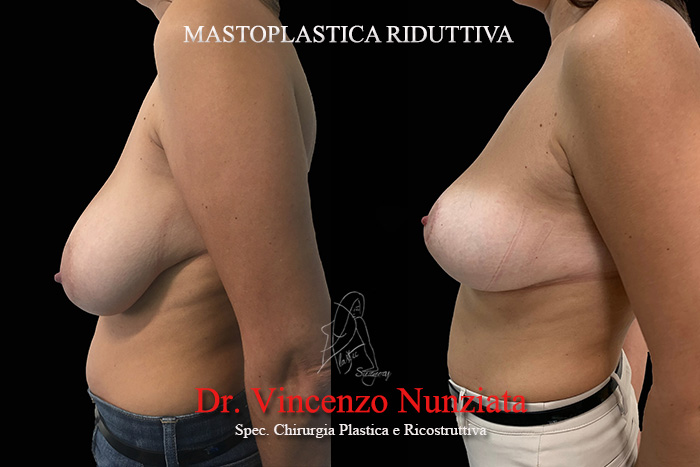 Mastopessi prima e dopo – Paziente 8 – Dr. Vincenzo Nunziata, chirurgo plastico – foto 2