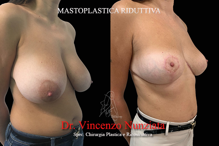 Mastopessi prima e dopo – Paziente 8 – Dr. Vincenzo Nunziata, chirurgo plastico – foto 4