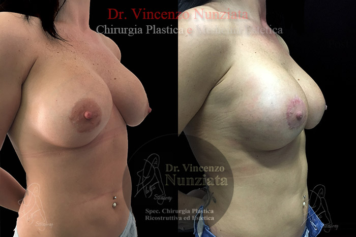 Revisioni mammarie prima e dopo – Paziente 5 – Dr. Vincenzo Nunziata, chirurgo plastico – foto 2