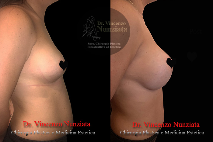 Revisioni mammarie prima e dopo – Paziente 4 – Dr. Vincenzo Nunziata, chirurgo plastico – foto 3