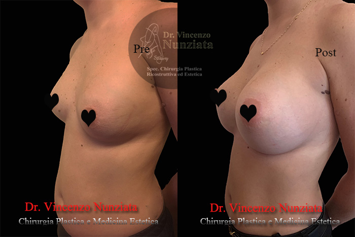 Revisioni mammarie prima e dopo – Paziente 4 – Dr. Vincenzo Nunziata, chirurgo plastico – foto 4
