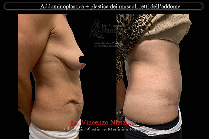 Addominoplastica prima e dopo – Paziente 18 – Dr. Vincenzo Nunziata, chirurgo plastico – foto 3