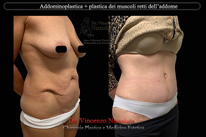 Addominoplastica prima e dopo – Paziente 18 – Dr. Vincenzo Nunziata, chirurgo plastico – foto 2