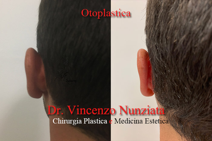 Otoplastica prima e dopo – Paziente 10 – Dr. Vincenzo Nunziata, chirurgo plastico