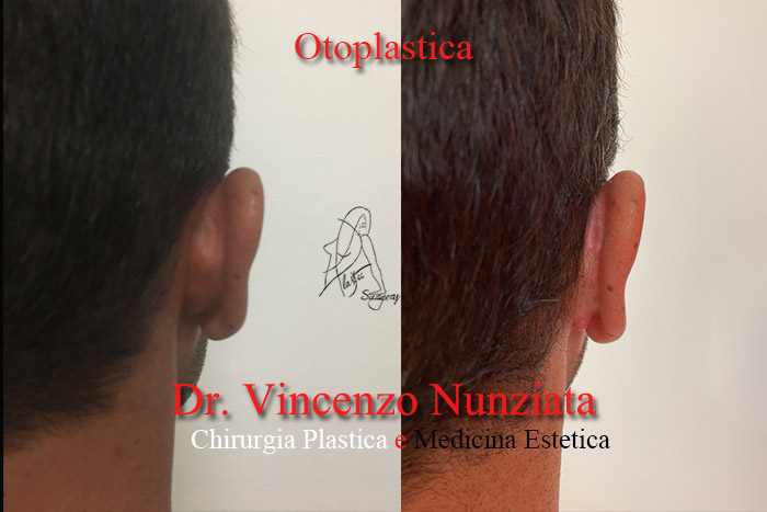 Otoplastica prima e dopo – Paziente 10 – Dr. Vincenzo Nunziata, chirurgo plastico – foto 2