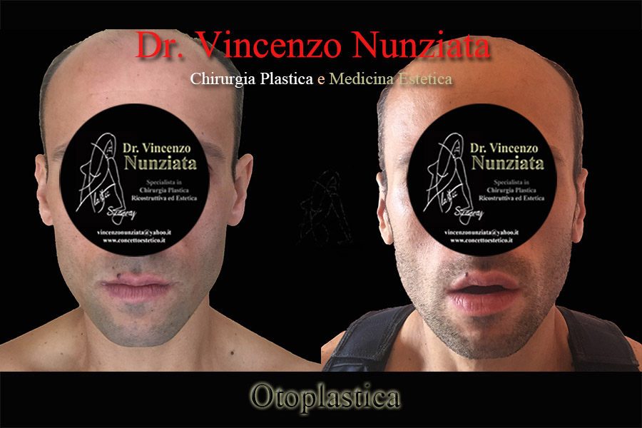 Otoplastica prima e dopo – Paziente 9 – Dr. Vincenzo Nunziata, chirurgo plastico